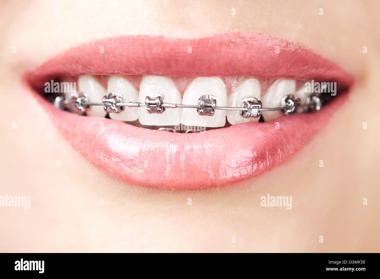 Zähne mit Zahnspangen Stockfoto