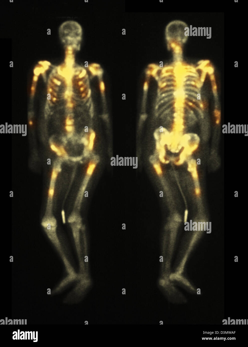 Knochen-Scan zeigt mehrere Metastasen Stockfoto