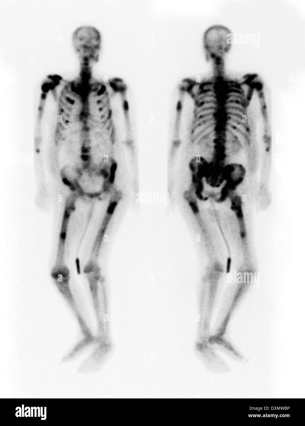 Knochen-Scan zeigt mehrere Metastasen Stockfoto