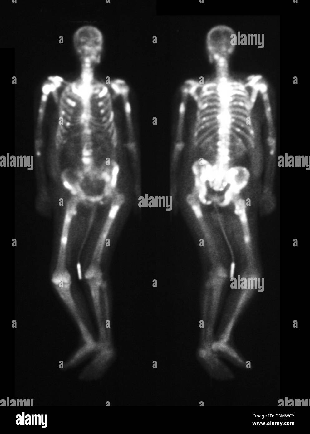 Knochen-Scan zeigt mehrere Metastasen Stockfoto