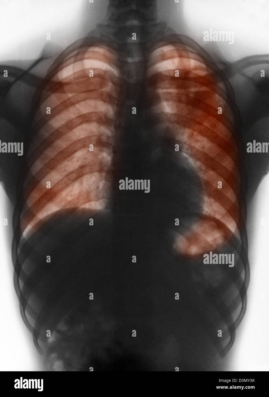 X-ray zeigt Tuberkulose bei einem Patienten in Nigeria Stockfoto