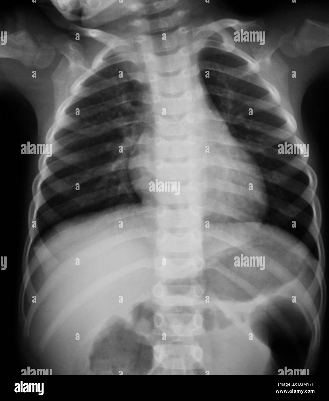 normalen Röntgenaufnahme eines 3-jährigen Jungen Stockfoto