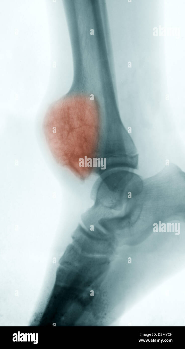 X-ray zeigt einen Tumor der distalen tibia Stockfoto