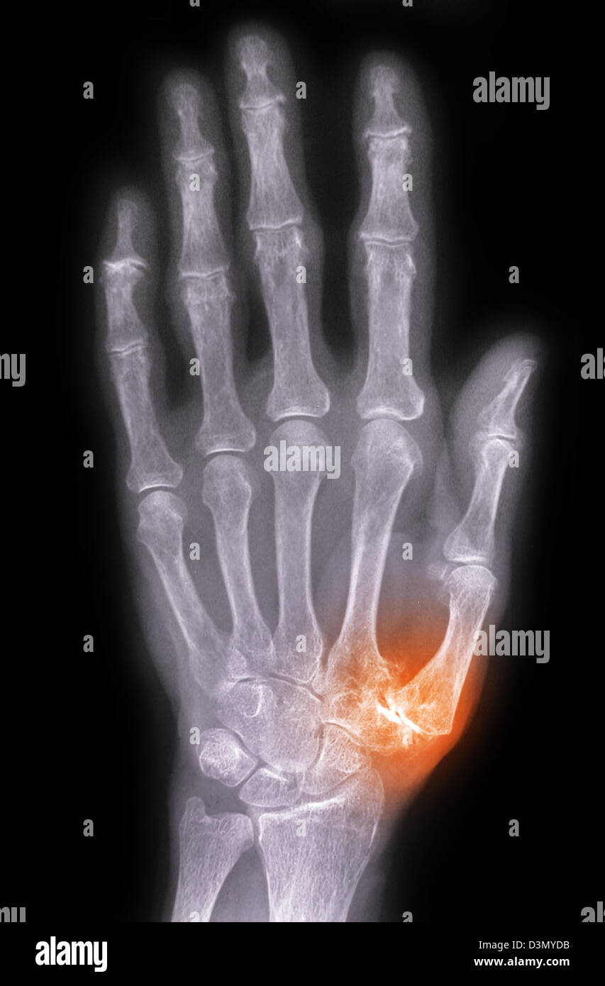 Röntgen der Hand eines älteren Mannes mit degenerativen arthritischen Erkrankungen an der Basis des Daumens Mittelhandknochen Stockfoto