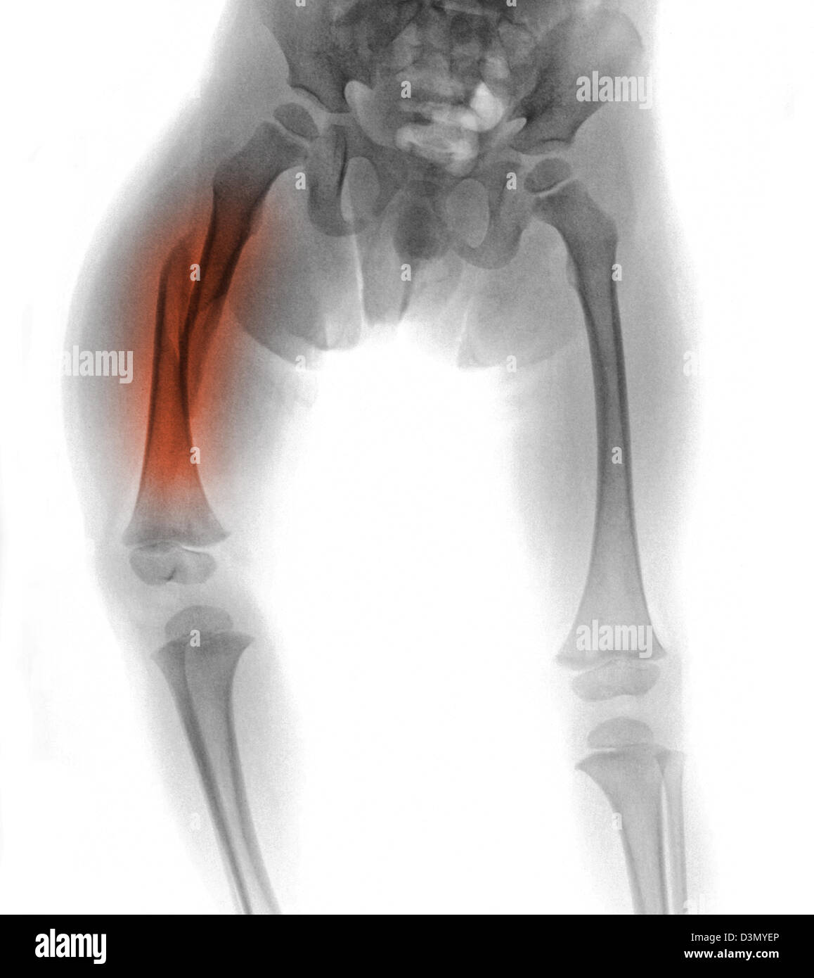 x-ray zeigt eine Femur Fraktur in ein 3 Jahre alter Junge, ein Opfer von Kindesmissbrauch Stockfoto