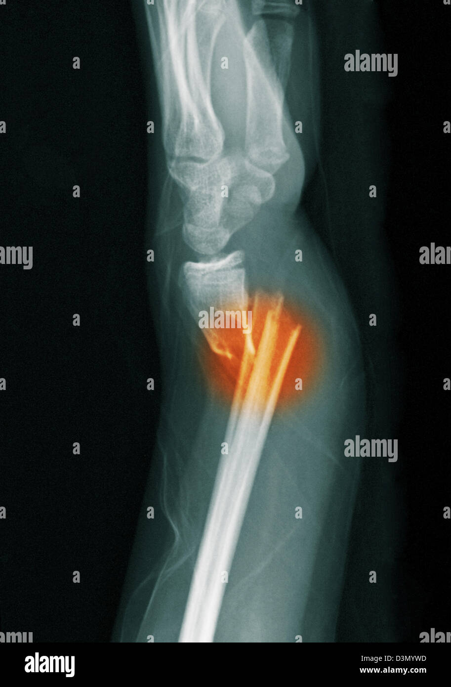 x-ray zeigen eine distale Radius und Ulna Fraktur in ein 12 Jahre altes Mädchen Stockfoto