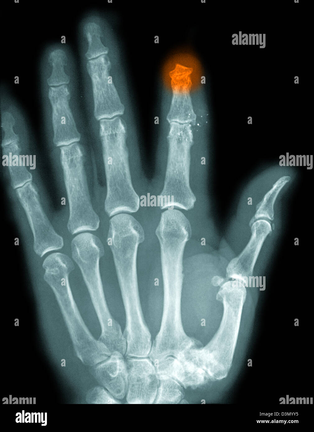 Röntgen der Hand eines erwachsenen Mannes zeigt die Amputation von der Spitze des Zeigefingers Stockfoto