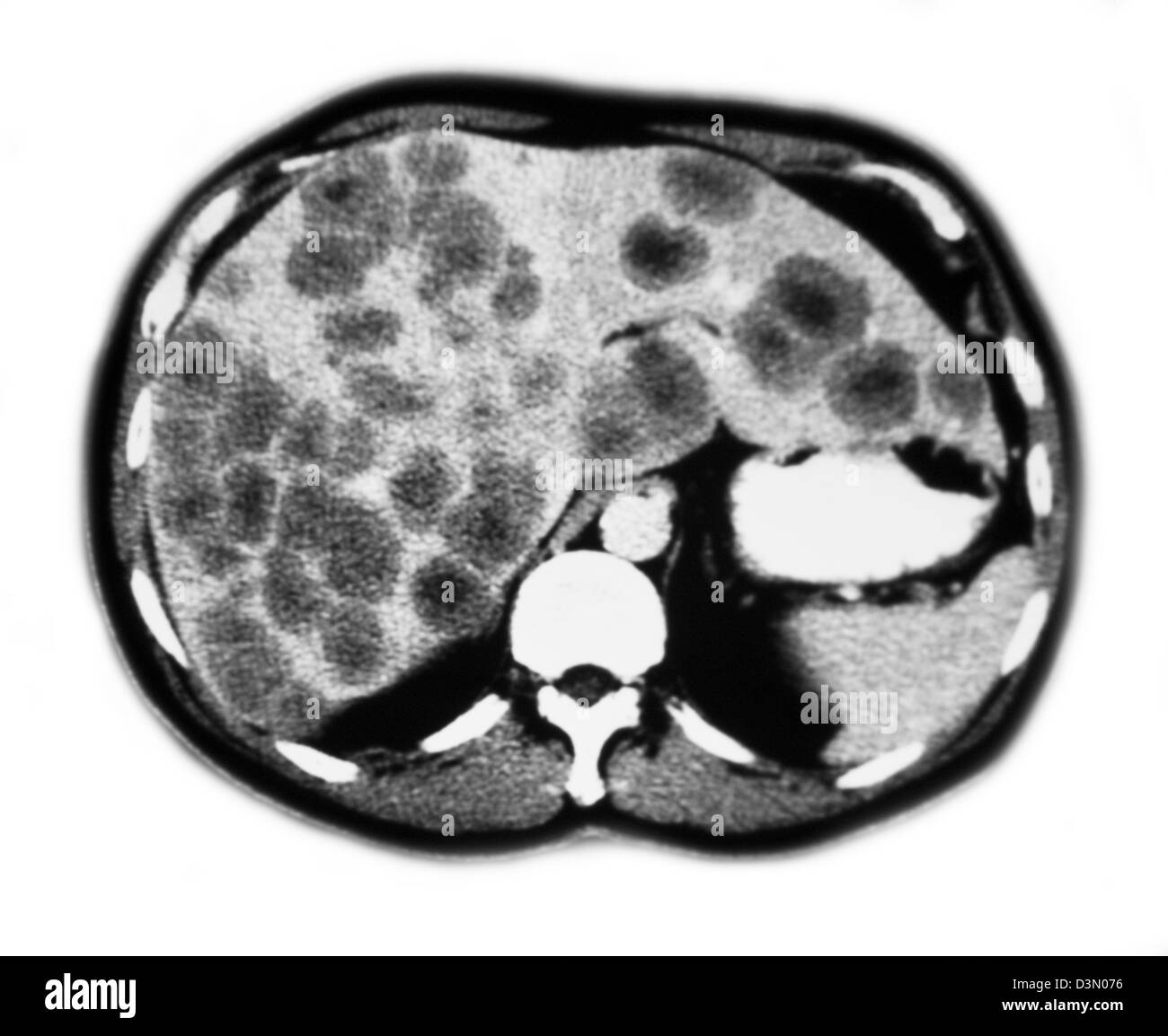 CT-Scan Scheiben zeigen umfangreiche metastasierendem Leberkrebs Stockfoto