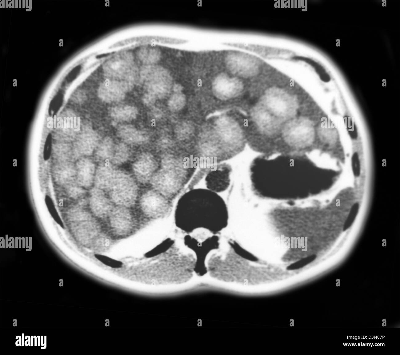 CT-Scan Scheiben zeigen umfangreiche metastasierendem Leberkrebs Stockfoto