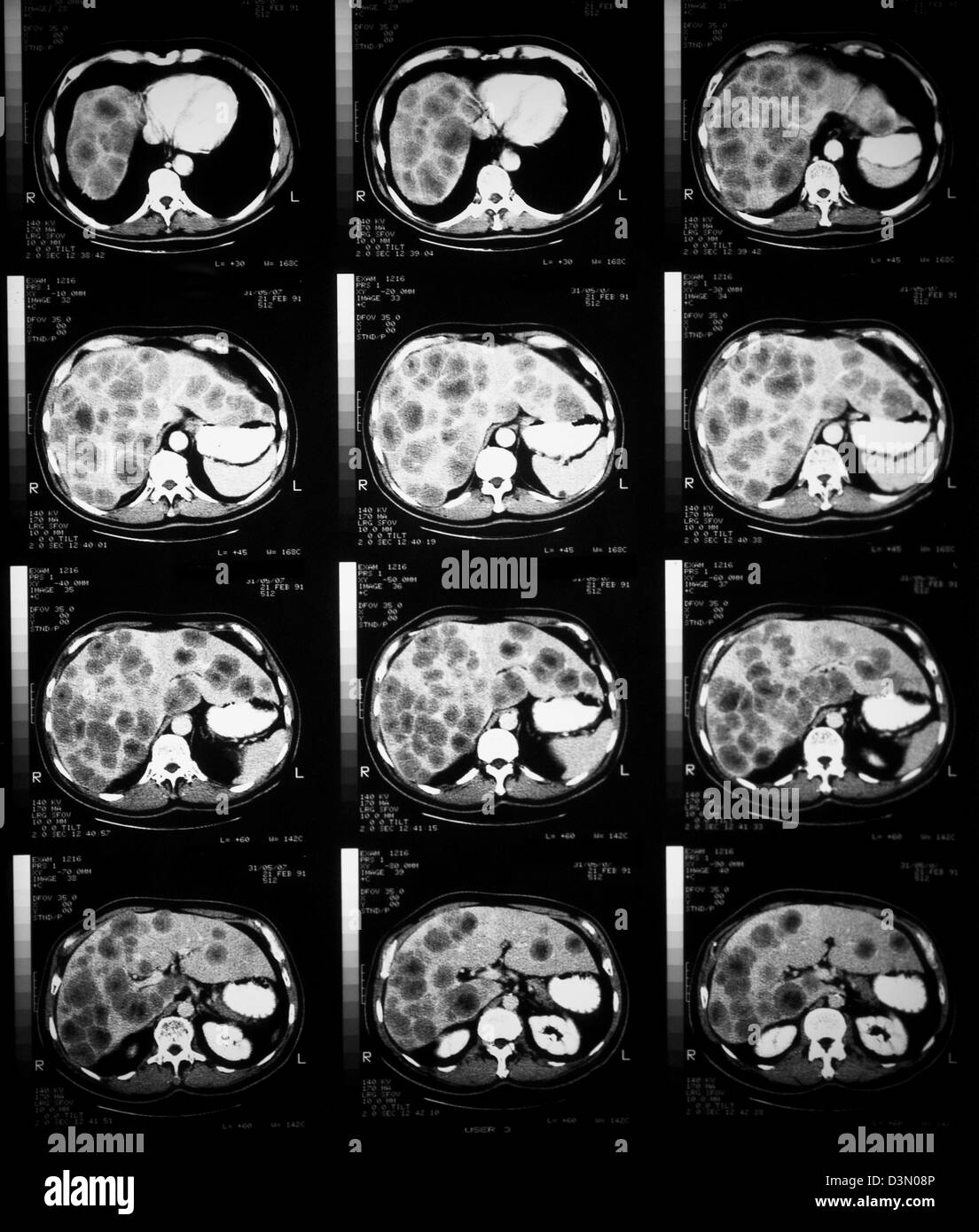 CT-Scan Scheiben zeigen umfangreiche metastasierendem Leberkrebs Stockfoto
