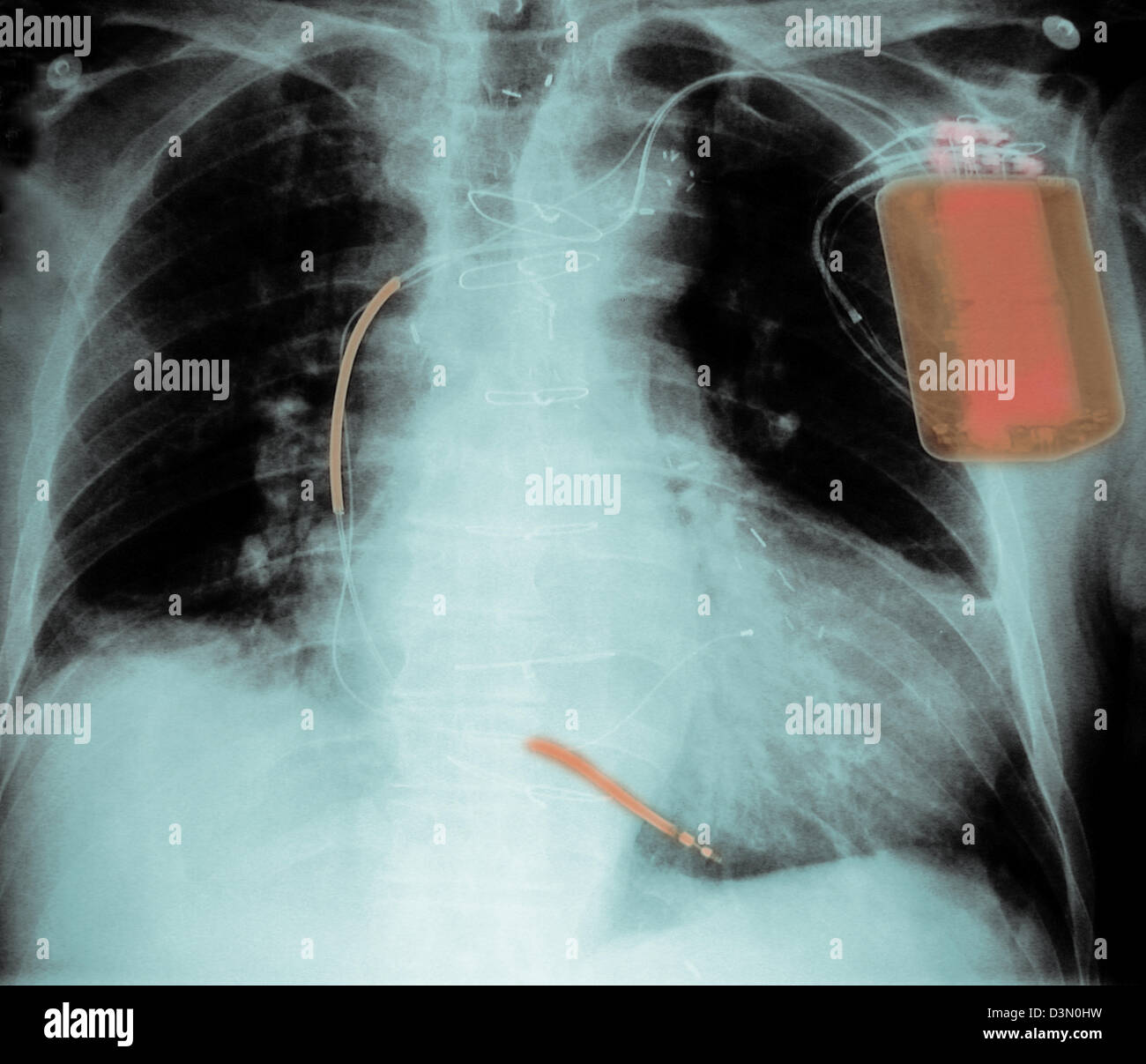 Röntgen-Thorax zeigt einen implantierten defibrillator Stockfoto