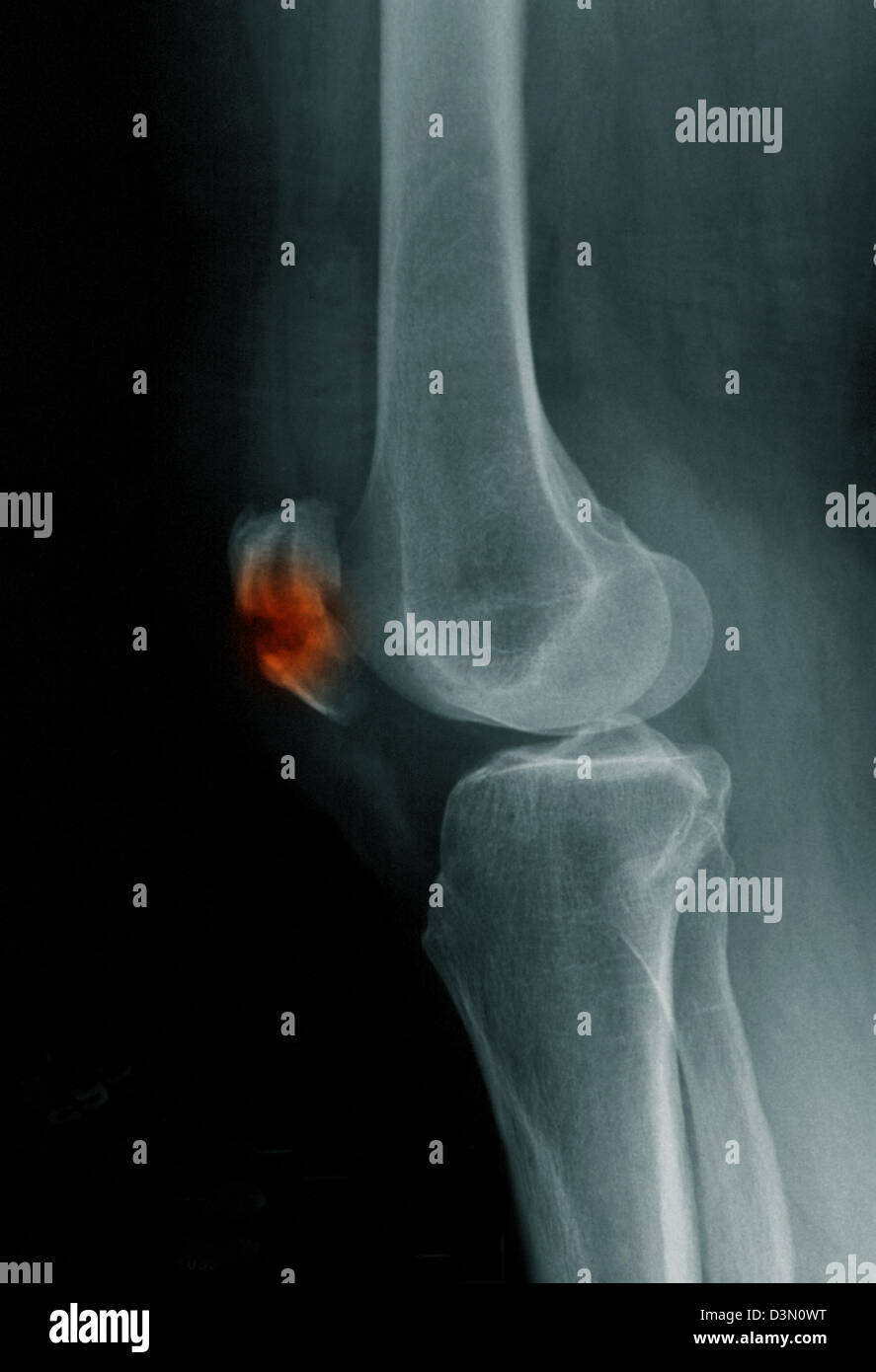 x-ray zeigt eine Fraktur der Patella, Kniescheibe Stockfoto