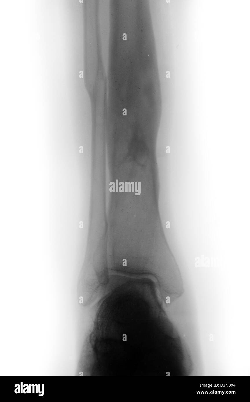 X-ray zeigt Osteomyelitis des Schienbeins aus einer offenen Fraktur Stockfoto