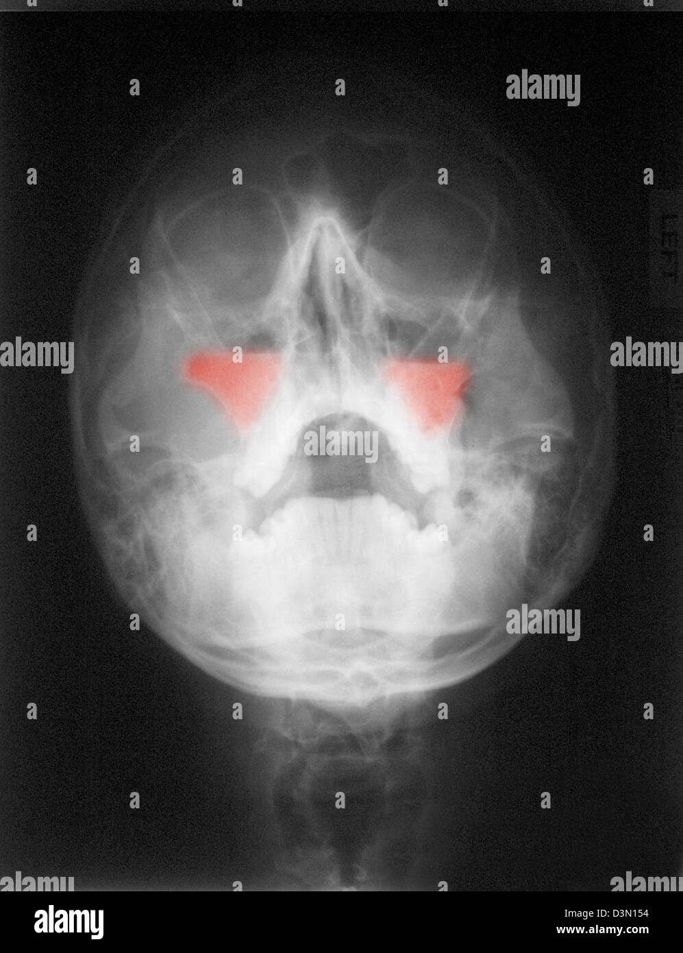 Schädel Röntgen zeigt bilaterale Kieferhöhle Frakturen Stockfoto