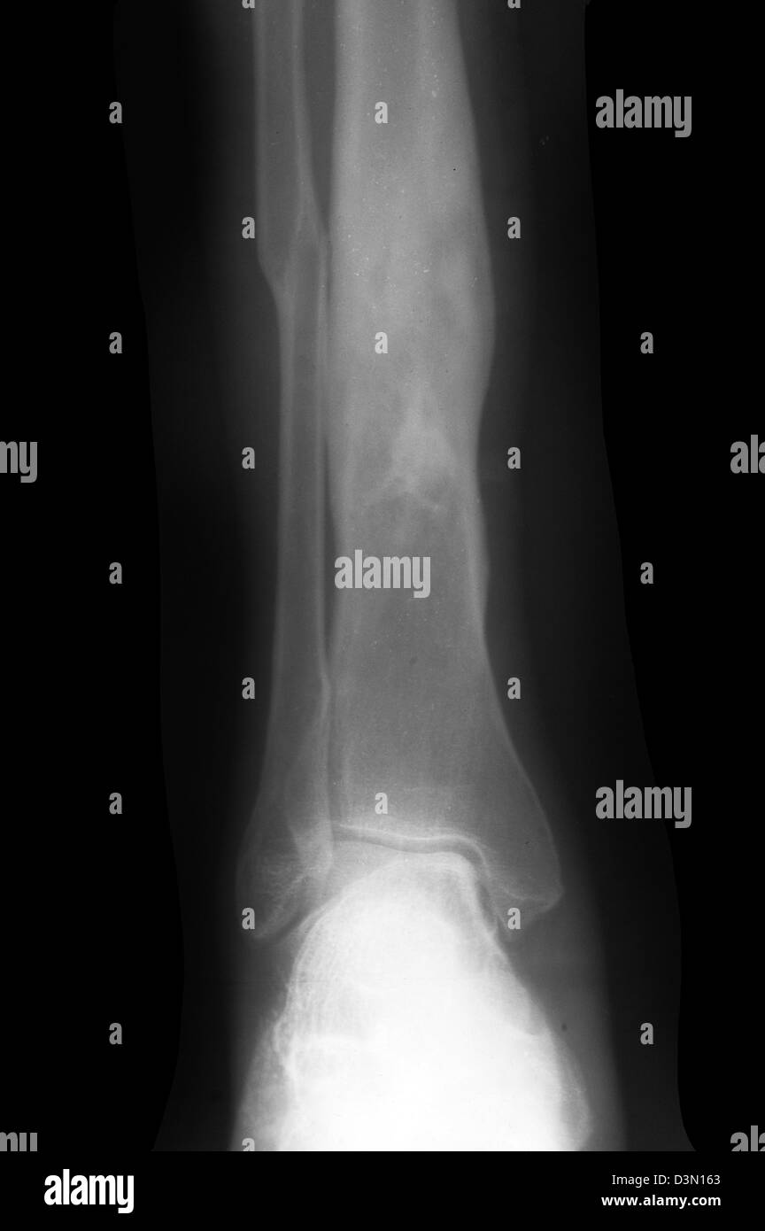 X-ray zeigt Osteomyelitis des Schienbeins aus einer offenen Fraktur Stockfoto