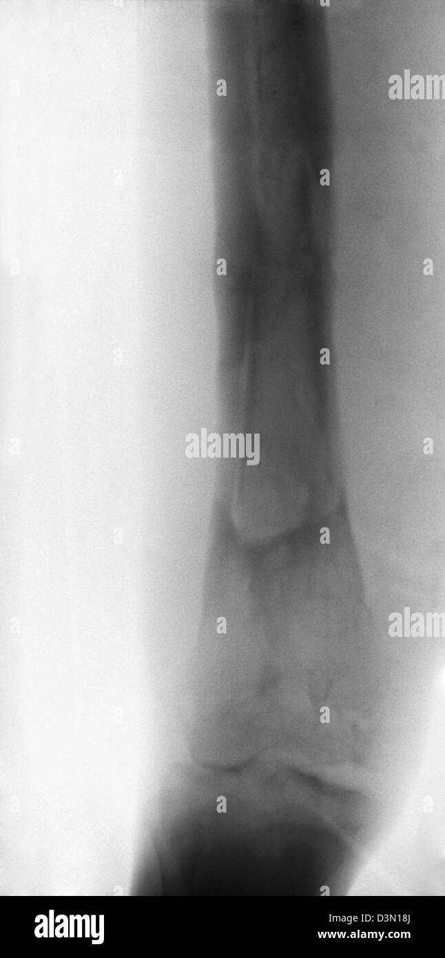 X-ray zeigt Osteomyelitis des Schienbeins aus einer offenen Fraktur Stockfoto