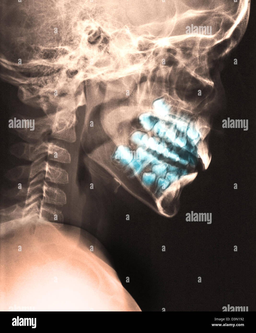 seitliche Schädel Röntgen eines Kindes, die die Entwicklung der Erwachsenen Zähne Stockfoto