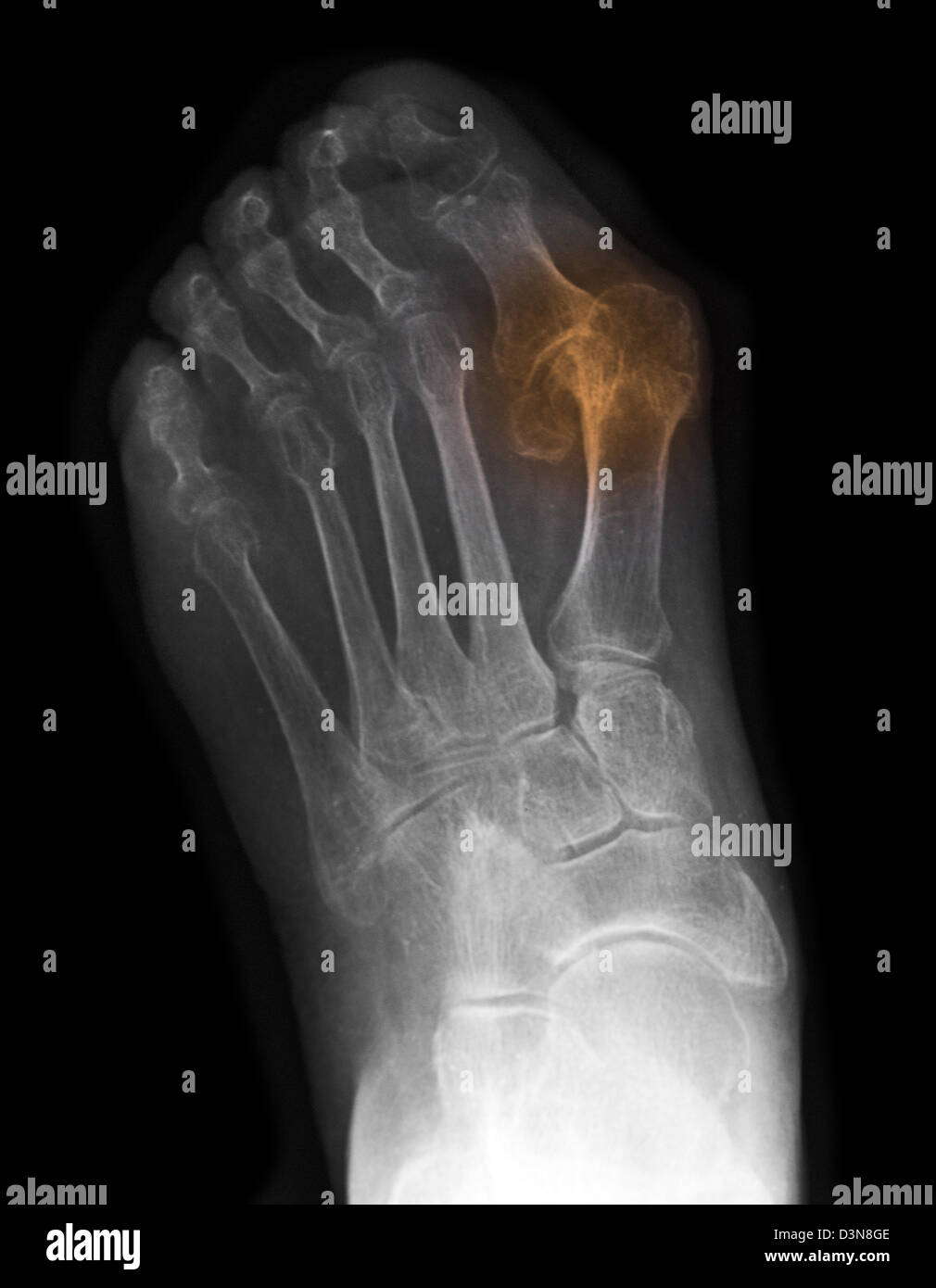 Röntgen des Fußes eine 83 Jahre alte Frau, die eine schweren Hallux valgus Deformität Stockfoto