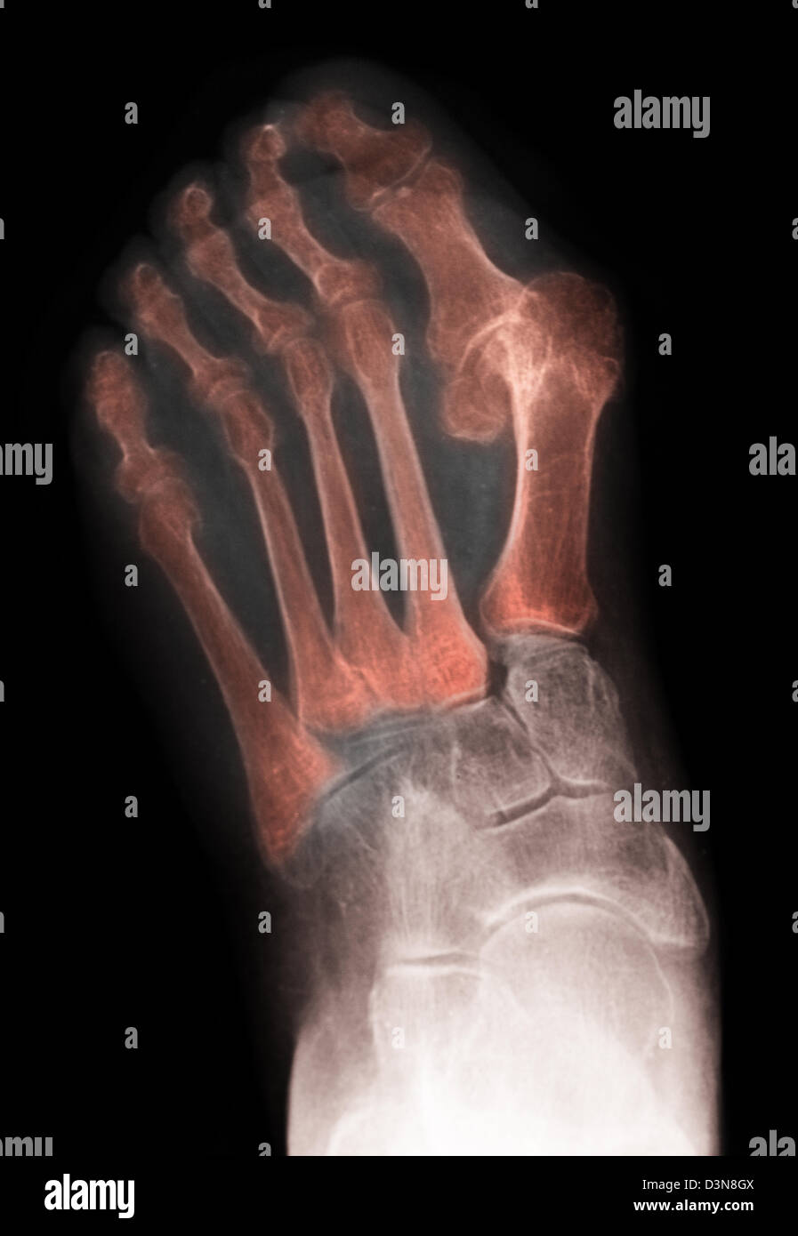 Röntgen des Fußes eine 83 Jahre alte Frau, die eine schweren Hallux valgus Deformität Stockfoto