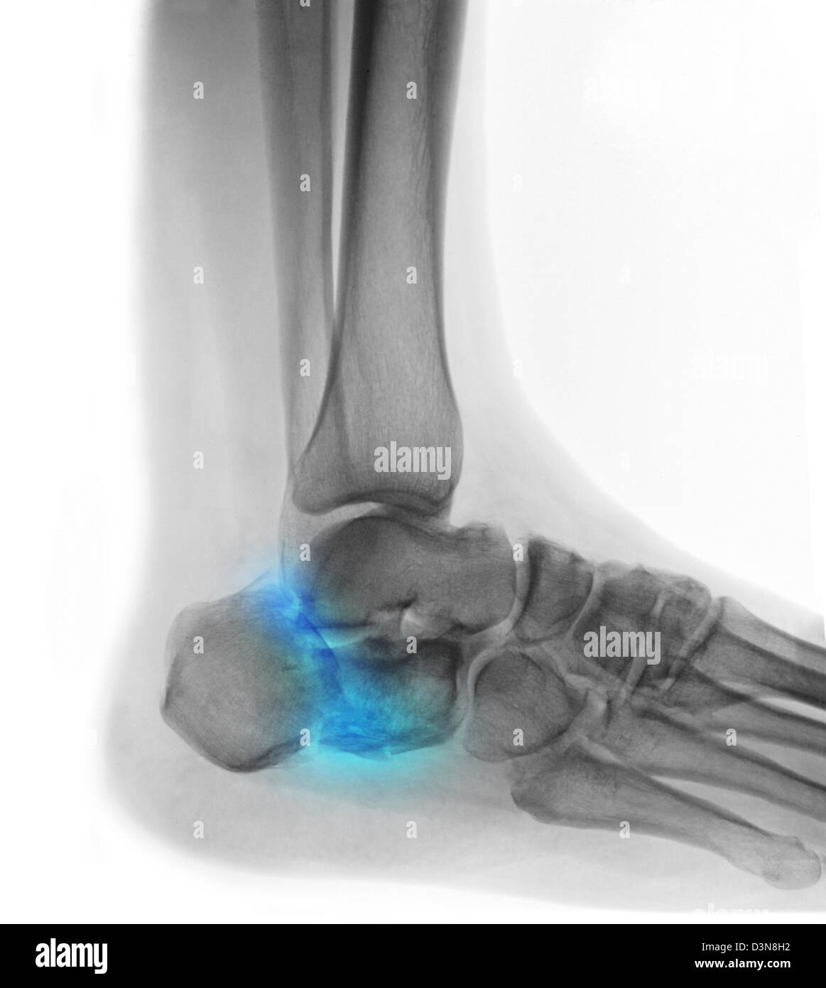 Röntgenaufnahme eines Mannes Fuß zeigt eine Fraktur der Ferse Stockfoto