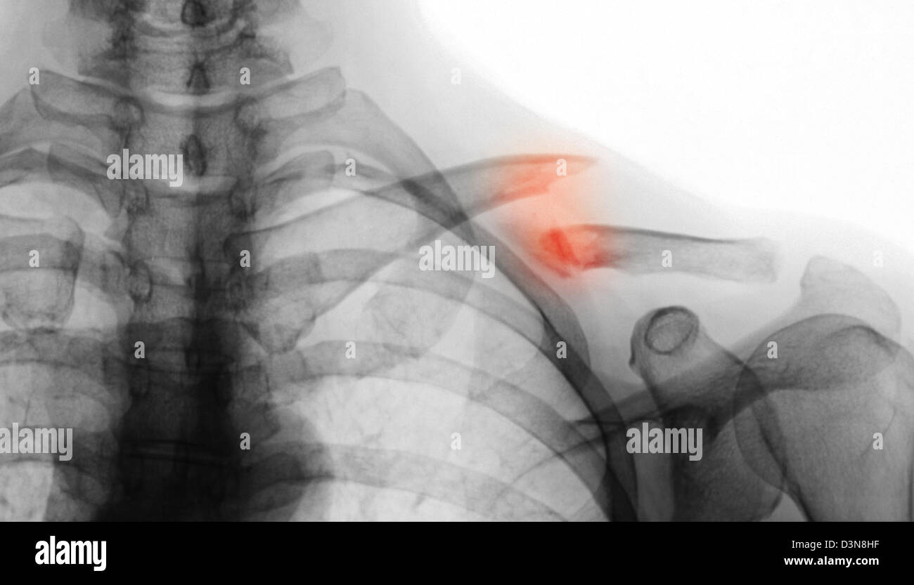 Röntgen der Schulter mit einer Schlüsselbein-Fraktur Stockfoto
