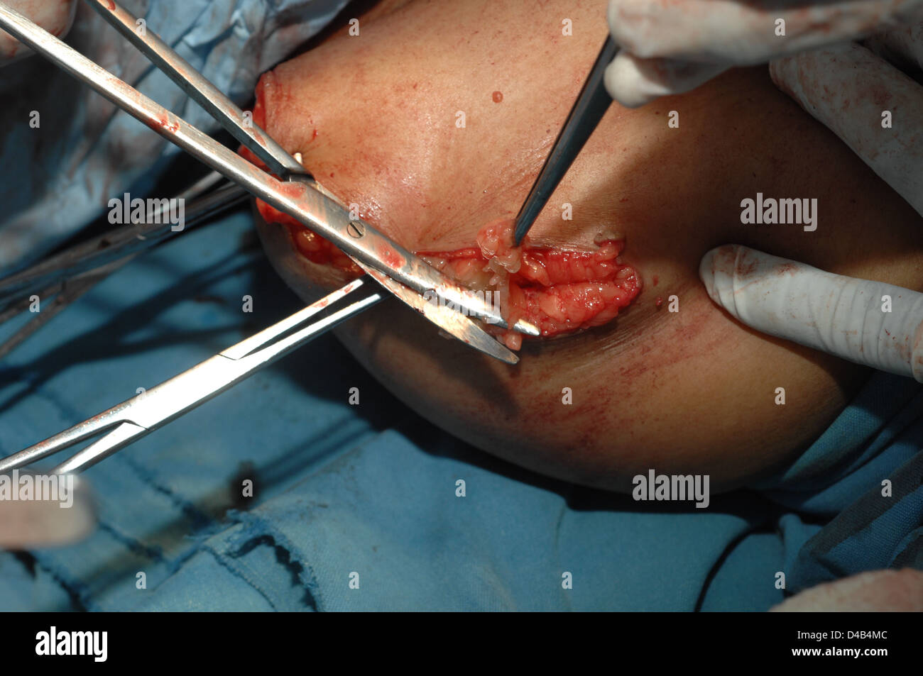 Klappen sind reapproximated und garniert mit Schere, nach der Amputation des rechten Beins. Stockfoto