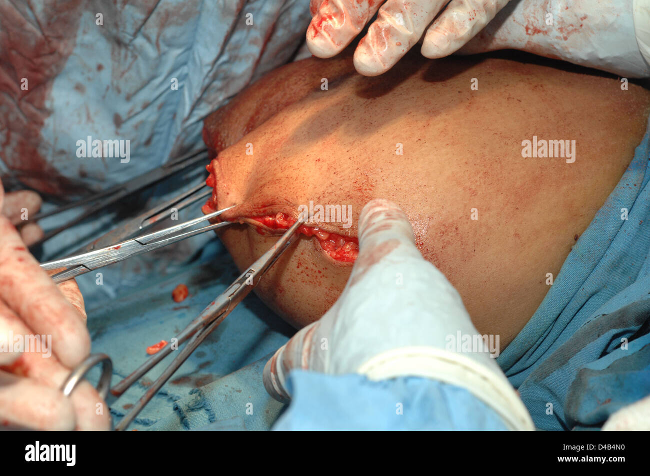 Allis Klammern anbringen Haut Kanten halten Wunde geschlossen, während Chirurgen enge Wunde nach Amputation rechtes Bein bereitet. Stockfoto