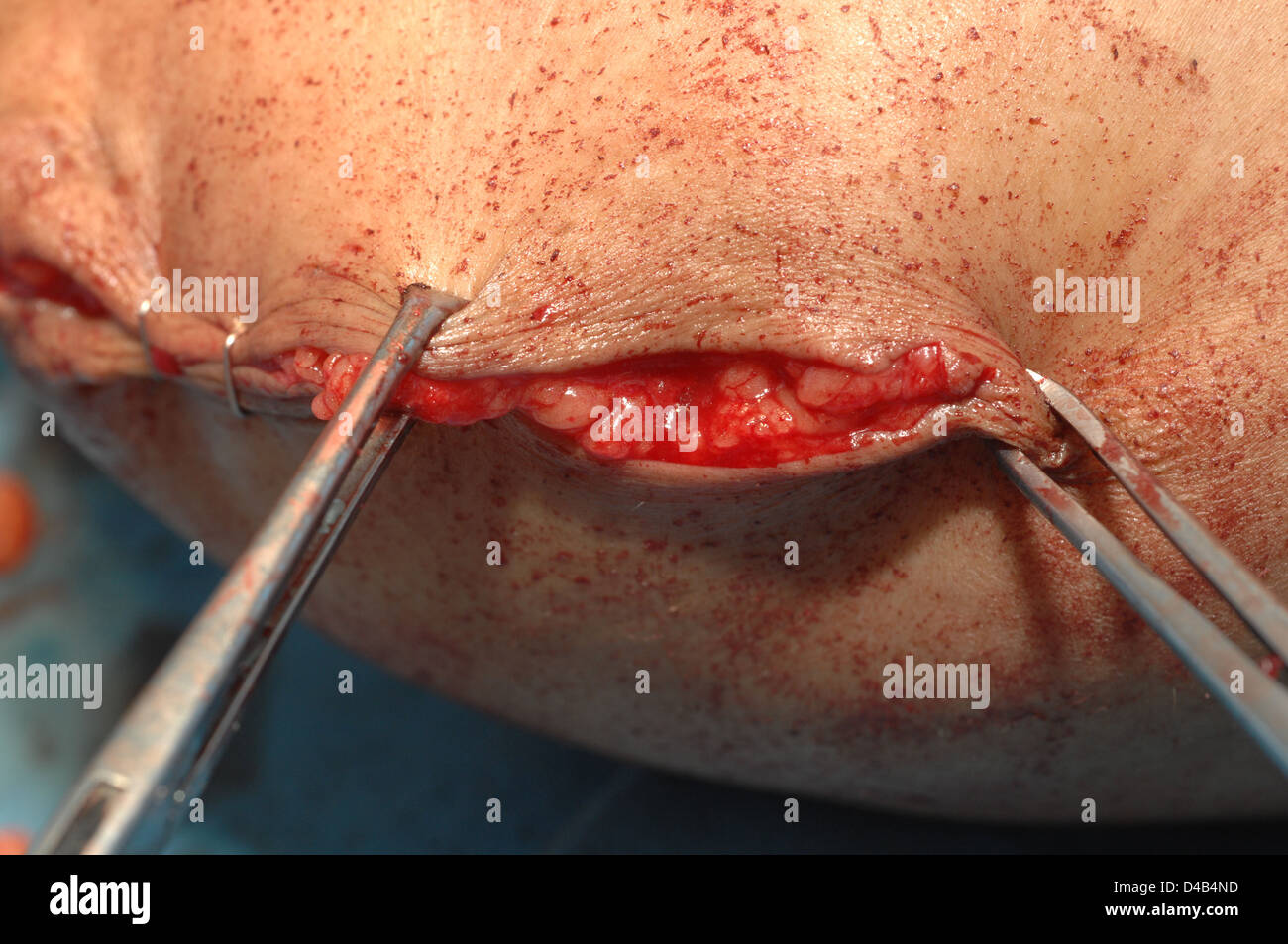 Klemmen sind einzeln freigegeben, also zugrunde liegende Haut kann nach der Amputation des rechten Beins geschlossen werden. Stockfoto