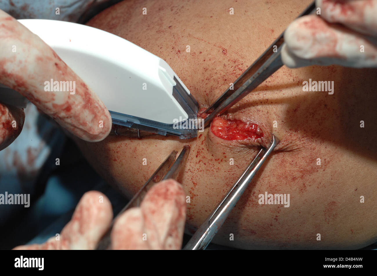 Chirurg legt die letzte Heftklammern Wundverschluss, nach der Amputation des rechten Beins. Stockfoto