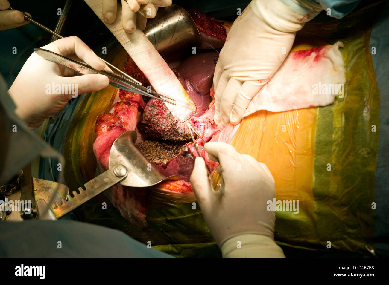 Chirurgen durchführen Lebertransplantation. Samsung Medical Center, Seoul, Südkorea. Stockfoto