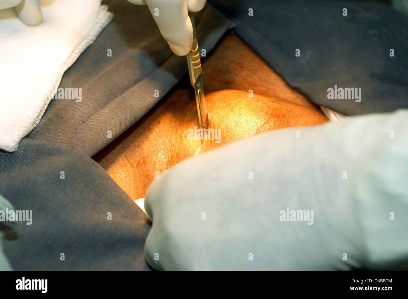 Der Chirurg gewinnt Zugang Schilddrüse im Hals-Schilddrüse produziert Hormone wie Thyroxin verantwortlich diktieren basale Stockfoto