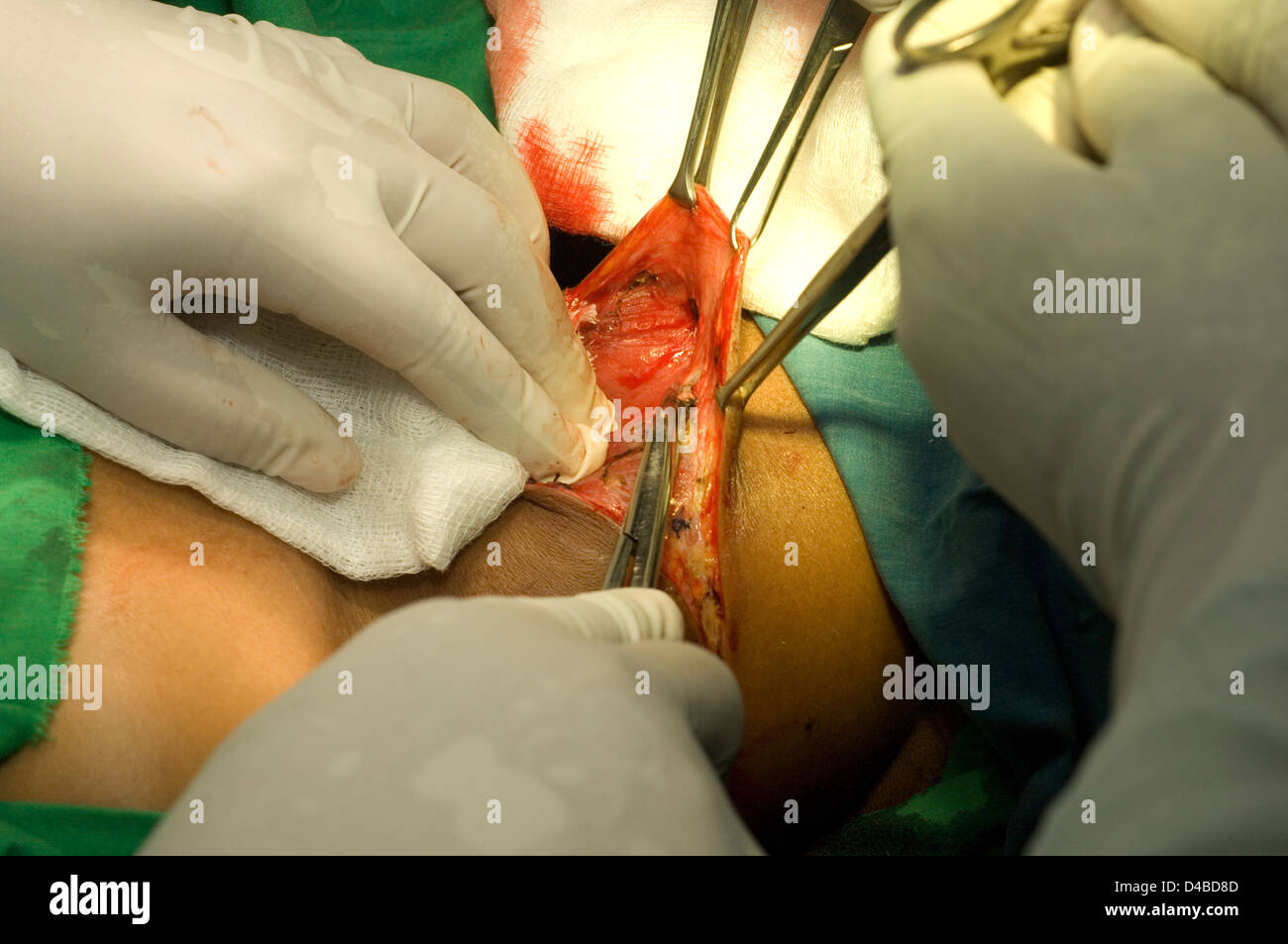 Thyreoidektomie. Assistent hält Allis Klemmen Haut zurückziehen, während Chirurgen Anker lose Subcutaenous Gewebe Kanten Wunde bereitet. Stockfoto