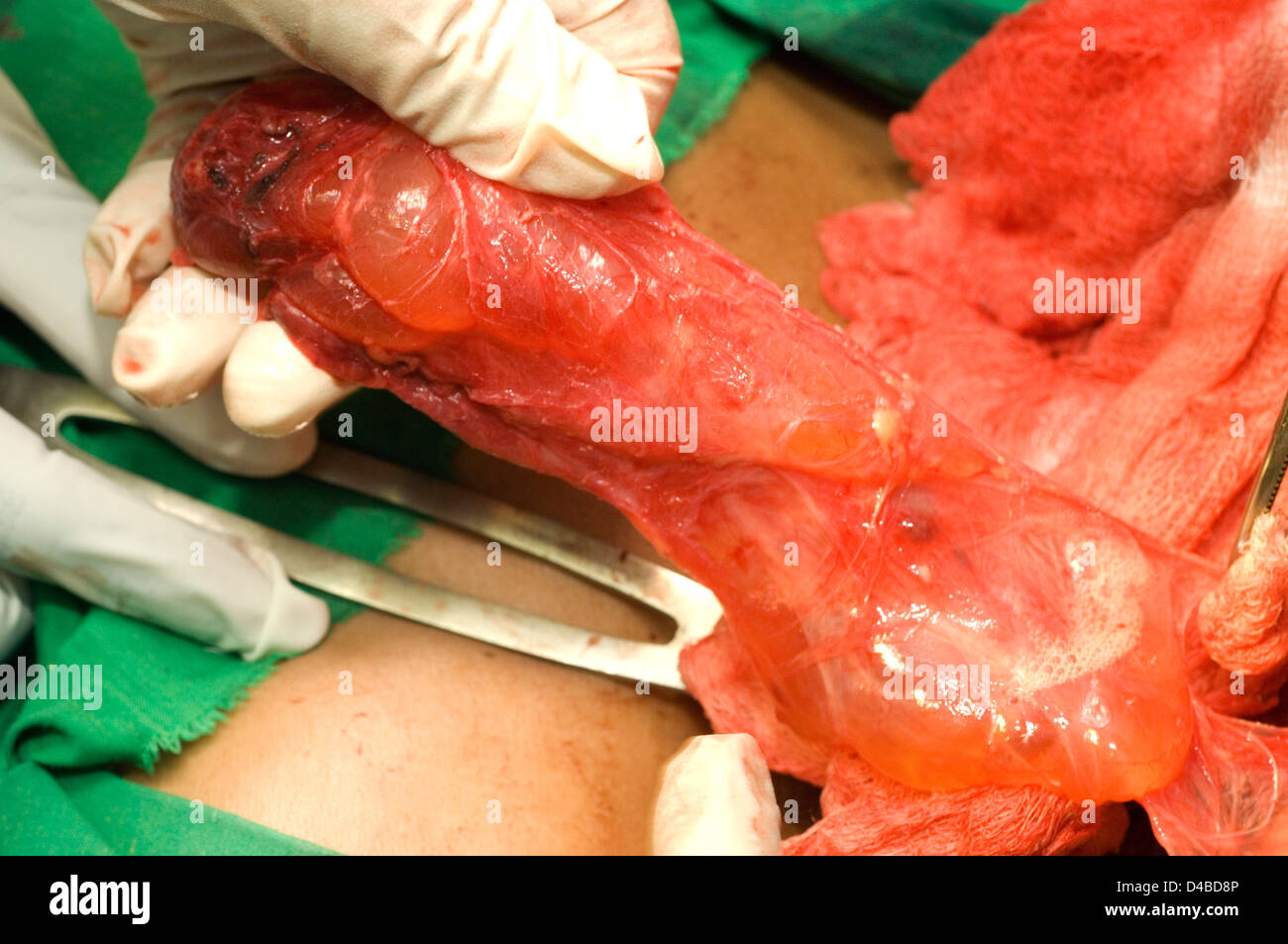 Chirurg ausgehend, abnorme Lappen bei Thyreoidektomie entfernen Stockfoto