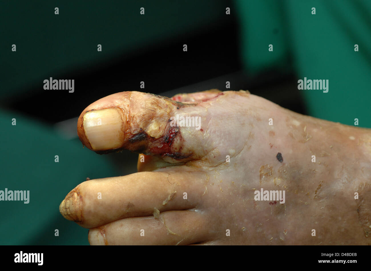 Diabetiker anfällige bakterielle Infektionen wie hoher Blutzucker einige Komponenten Immunsystem hemmt Verlust gekoppelt Stockfoto