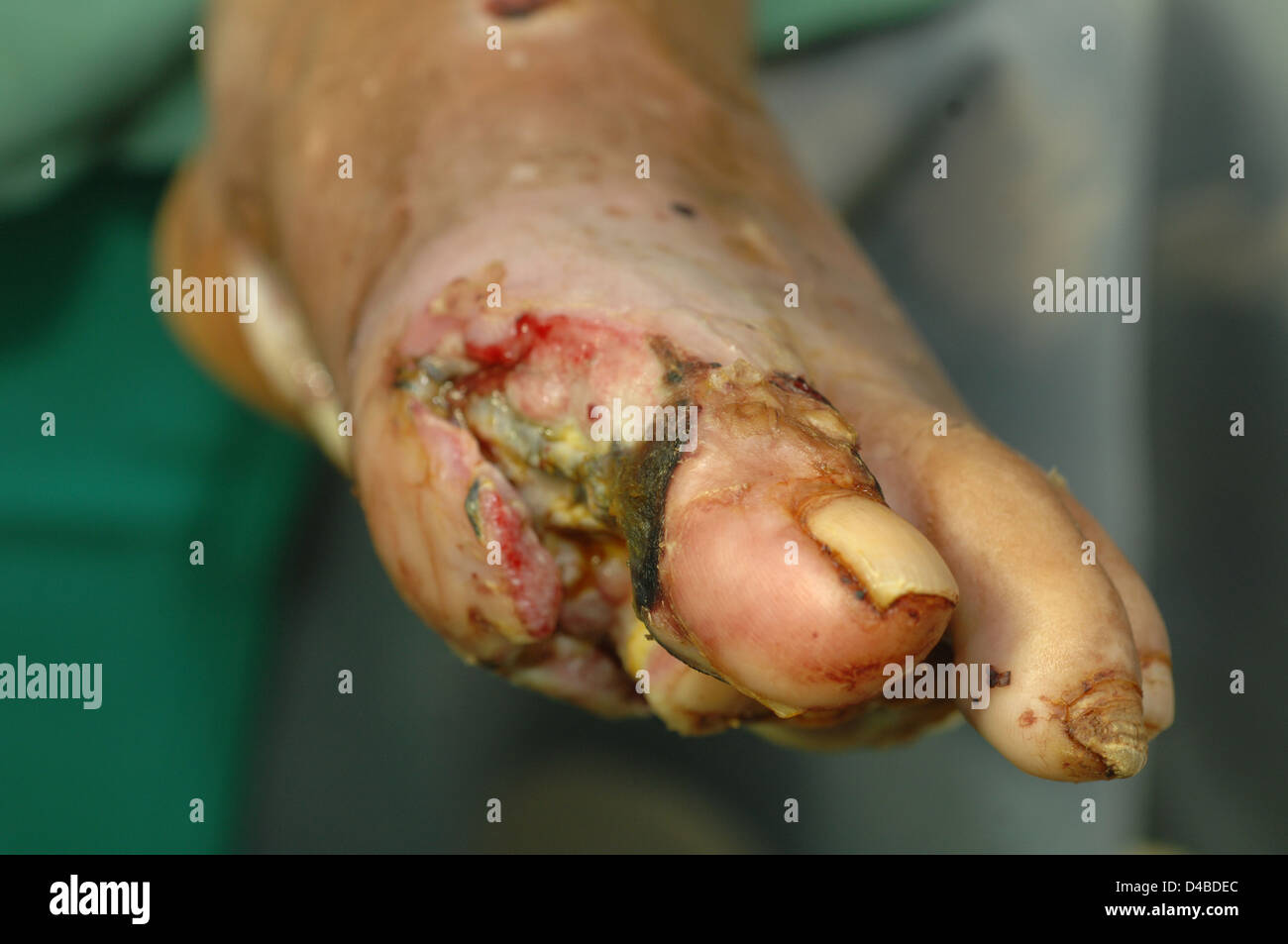 Diabetiker anfällige bakterielle Infektionen wie hoher Blutzucker einige Komponenten Immunsystem hemmt Verlust gekoppelt Stockfoto