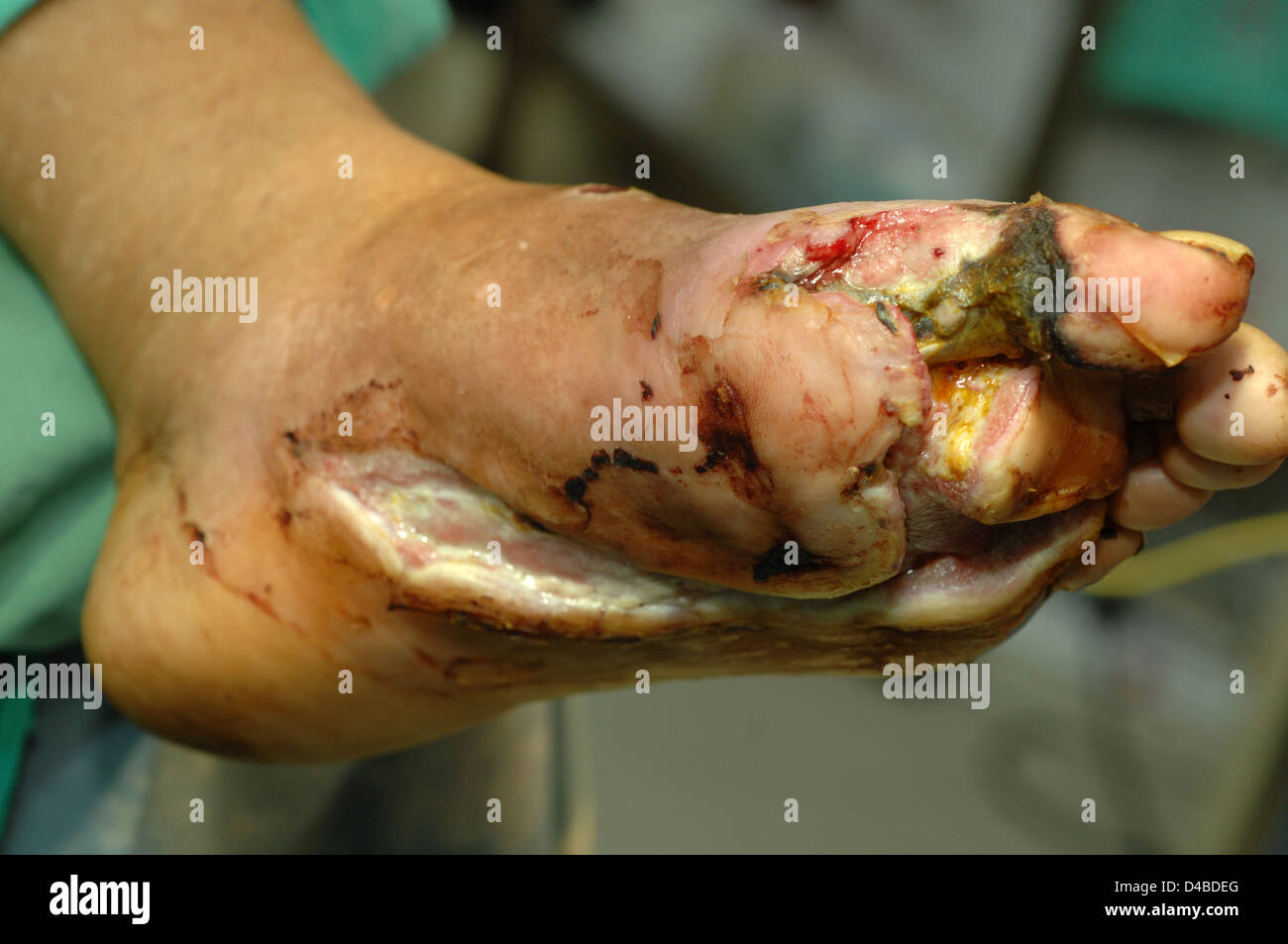 Diabetiker anfällige bakterielle Infektionen wie hoher Blutzucker einige Komponenten Immunsystem hemmt Verlust gekoppelt Stockfoto