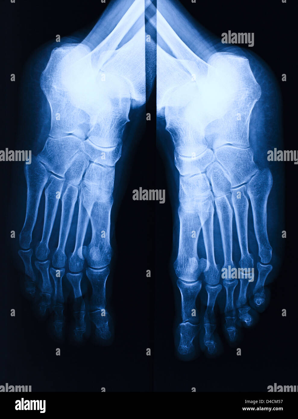 Bild des blauen Fuß xray Stockfoto