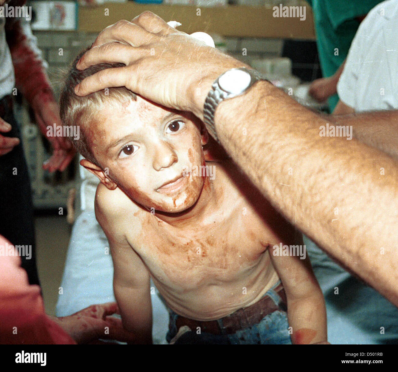 MOSTAR, Bosnien, AUGUST 1993---eine verletzte bosnisch-kroatische Junge sitzt nach einer Verwundung von einer Mörsergranate, die vor seinem Haus fiel, während er spielte fassungslos in die Notaufnahme eines Krankenhauses. Kämpfe zwischen bosnischen Kroaten und bosnischen Moslems um die Kontrolle über die historische Stadt geht in das zweite Jahr. Stockfoto