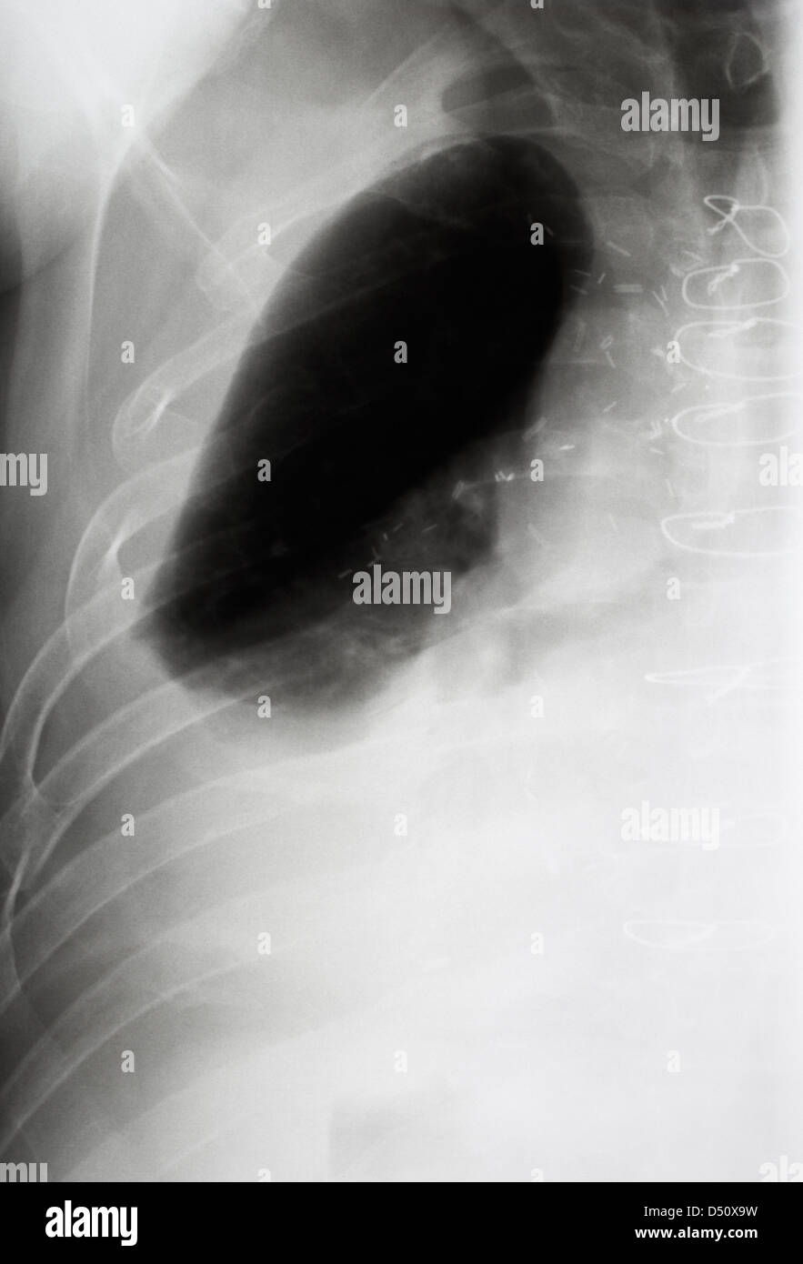Berlin, Deutschland, Roentgenaufnahme Seite der knöchernen Brust eines Mannes Stockfoto