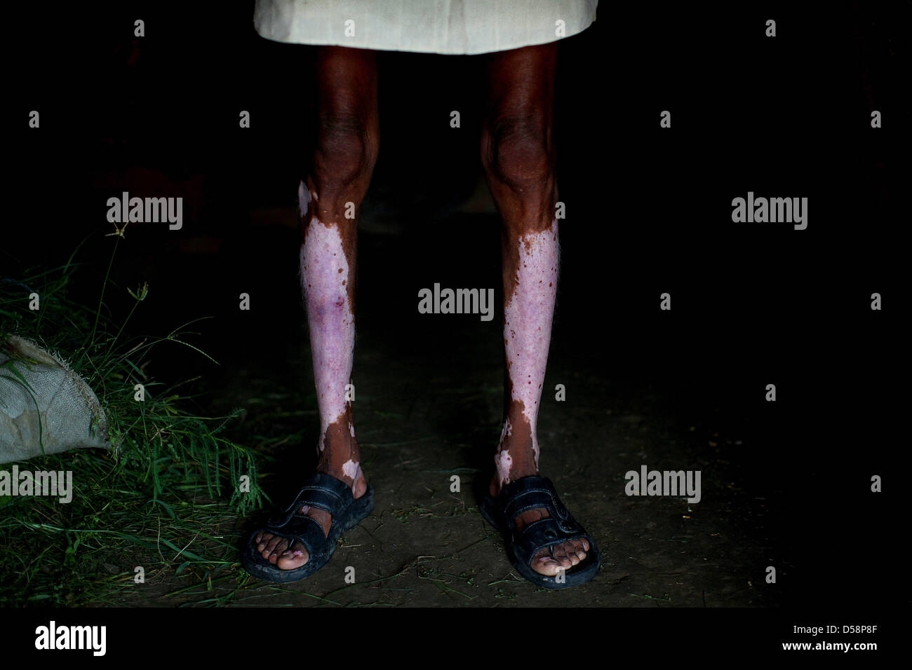 Hautdepigmentierung Fotos und Bildmaterial in hoher Auflösung Alamy