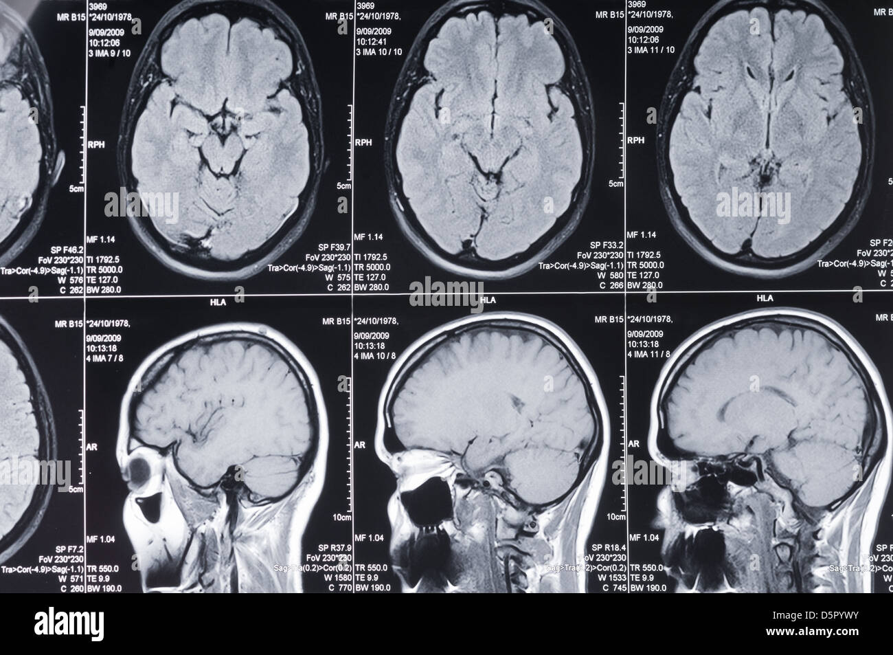 Nahaufnahme eines Computer axiale Tomographie Scans (CT) des Kopfes Stockfoto