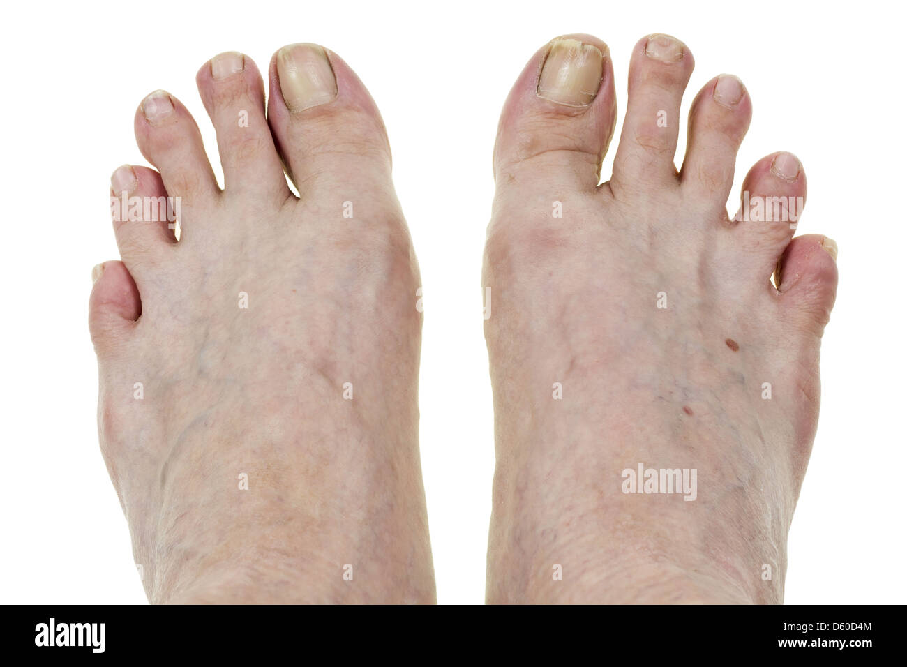 Füße und abgebrochene Nägel Stockfoto