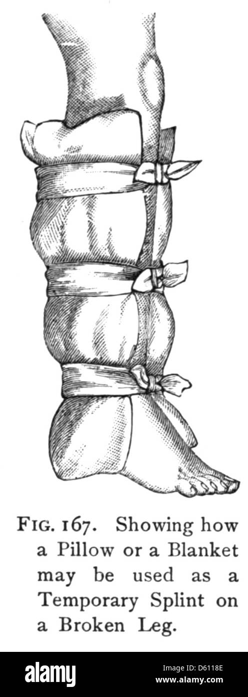 Dieses ca. 1910 erschienene Bild von „Life and Health“ zeigt eine physiologische Untersuchung der menschlichen Anatomie, einschließlich eines Schwerpunkts auf der Behandlung von Verletzungen mit Decken, Kissen und Schienen für die medizinische Versorgung. Stockfoto