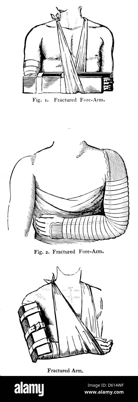 Eine Illustration aus dem 1878 erschienenen „Domestic Cyclopædia of Practical Information“, die die Behandlung eines gebrochenen Arms darstellt und praktische Ratschläge zur medizinischen Versorgung bietet. Stockfoto