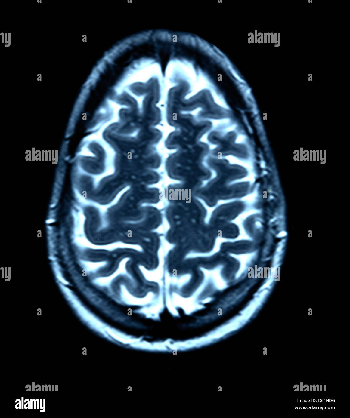 Gehirn-Scan, MRI scan Stockfoto