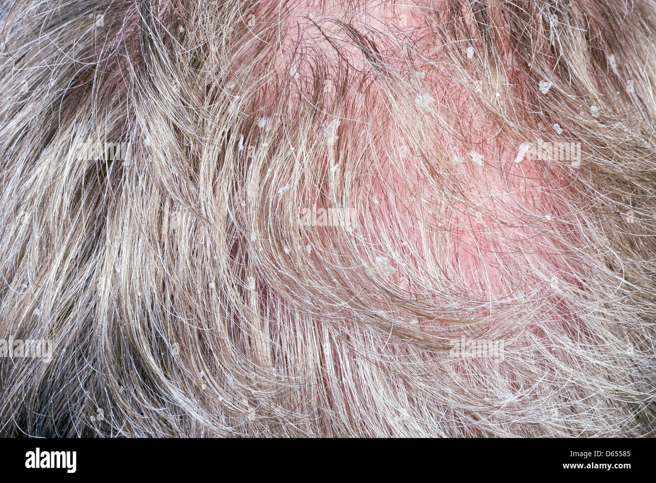 Schuppen in ein graues Haar von der wachsenden älteren Glatzkopf Konzept Makro. Faston-Fokus Stockfoto