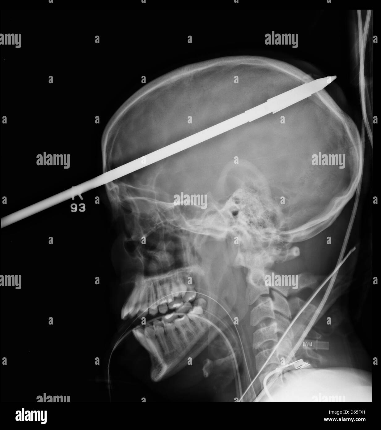 (HANDOUT) Ein undatiertes Handout zeigt ein Röntgenbild der Harpune im Kopf des 16 Jahre alten Schüler, die während einer Pressekonferenz in Miami, Florida, USA, 18. Juni 2012 Yasser Lopez in den Medien öffentlich gemacht. Der junge wurde von einem Freund in den Kopf geschossen, während Speer Angeln am 07 Juni vor zwei Wochen. Ärzte im Jackson Memorial Hospital in Miami, Florida konnten die Harpune in einem Ris zu entfernen Stockfoto