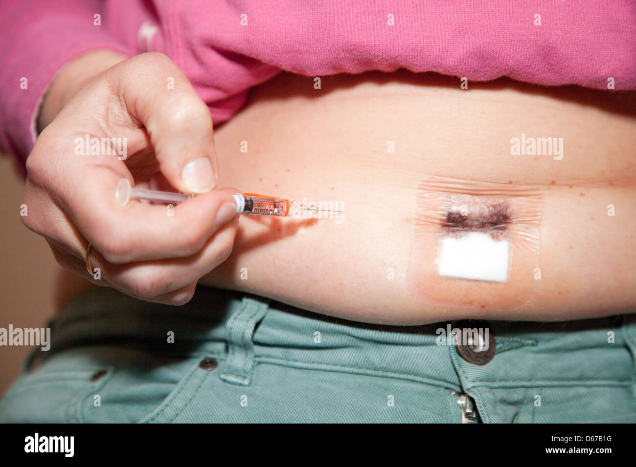 Frau tut Selbstinjektion von gerinnungshemmenden Heparin zu postoperativen Thrombose (TVT), UK Stockfoto