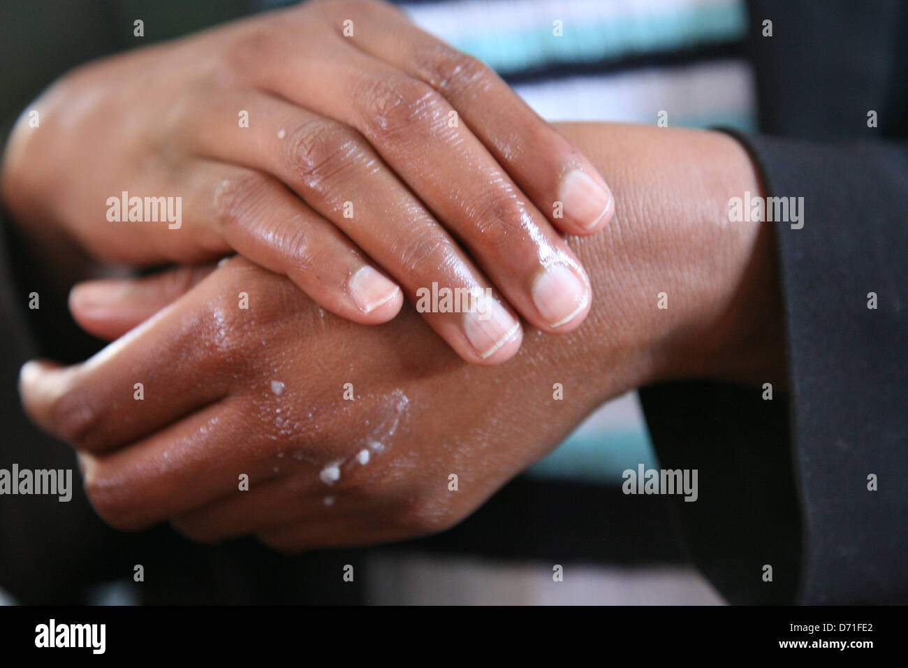 Nahaufnahme von weiblichen Händen mit Hautausschlag Vaseline Honig Stockfoto