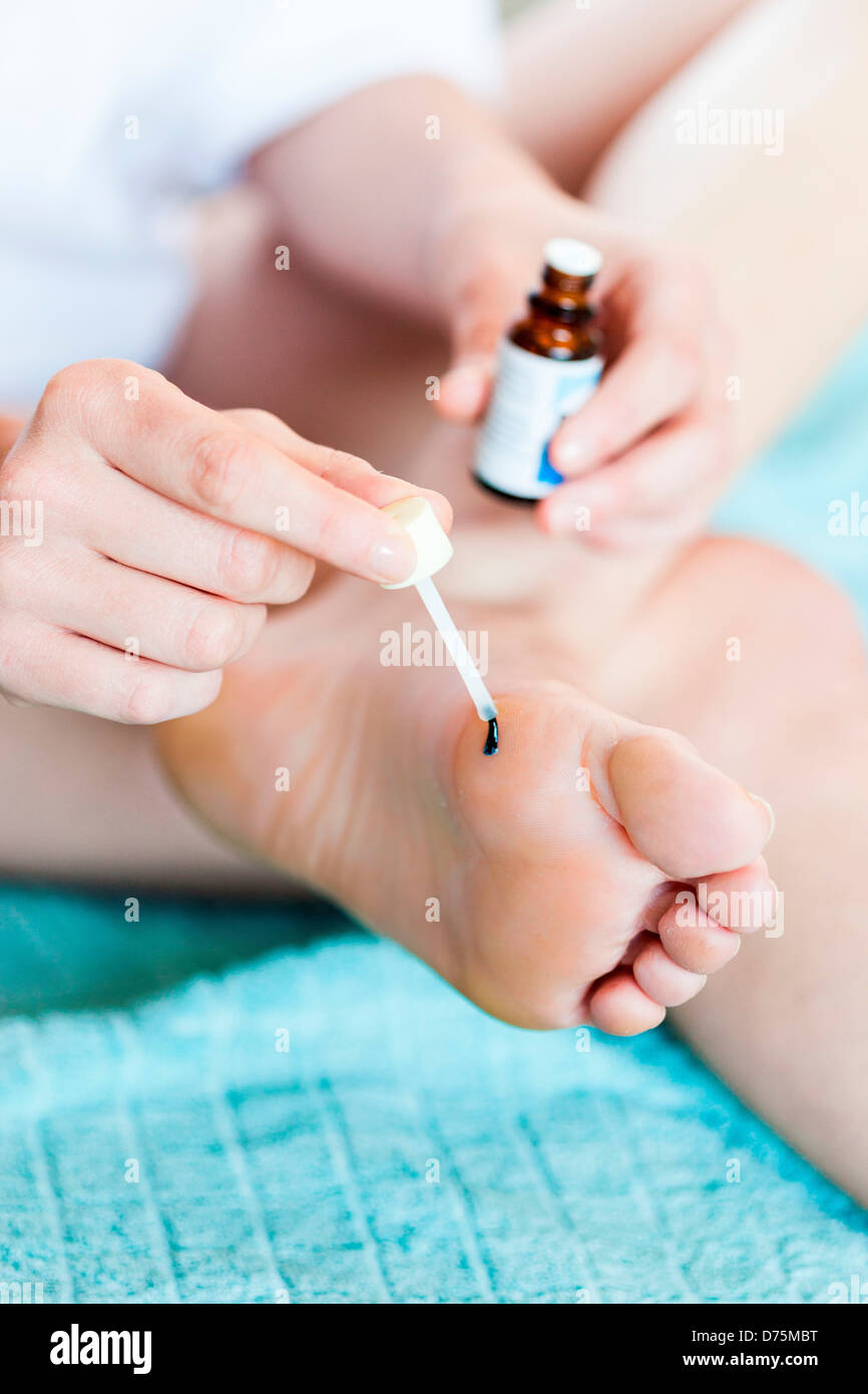Verruca foot -Fotos und -Bildmaterial in hoher Auflösung – Alamy